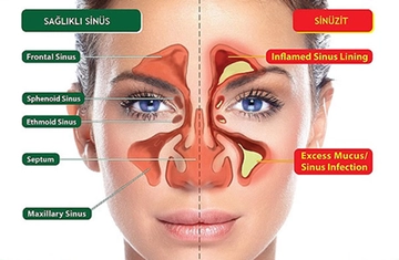 Sinüs Özellikleri ve Faydaları Nelerdir?