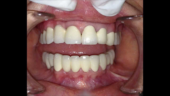 Diş Sinüs Ameliyatı Riskleri ve Sonrası