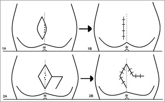 Pilonidal Sinüs Belirtileri ve Tedavisi