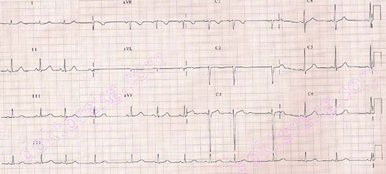 Sinüs Aritmisi Özellikleri ve Faydaları Nelerdir?