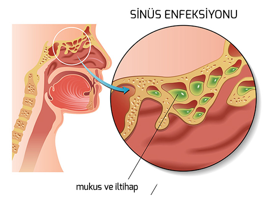 Sins Enfeksiyonu