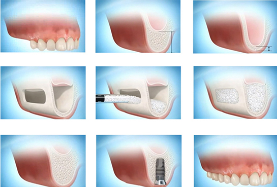 Sinüs Lifting Riskleri ve Sonrası