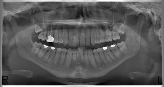 Sinüslerde Kist Belirtileri ve Tedavisi